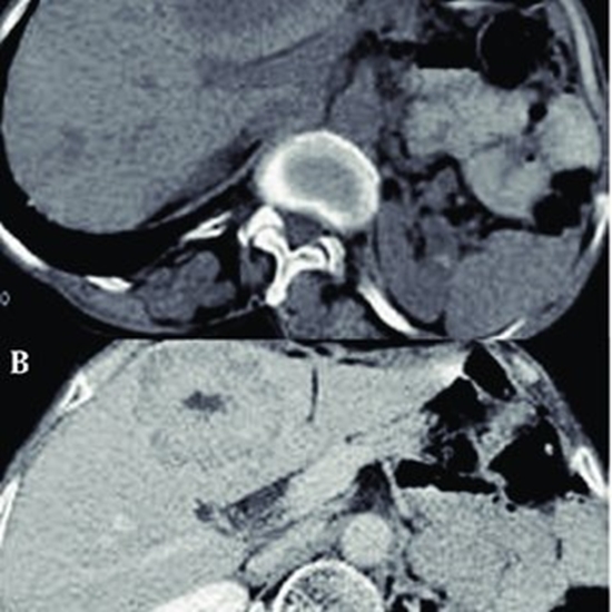 Imaging and Imaging-Guided Interventions in the Diagnosis and Management of Hepatocellular Carcinoma (HCC)-Review of Evidence {faces}